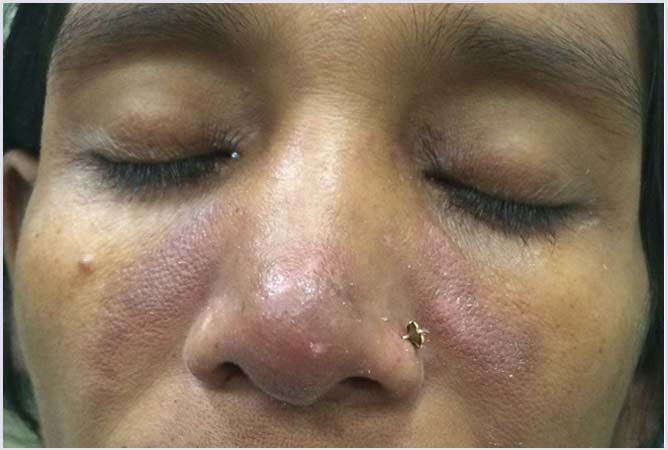 Systemic Lupus Erythematosus
