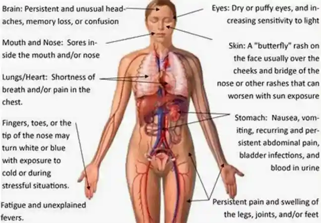 Lupus Sign & Symptoms