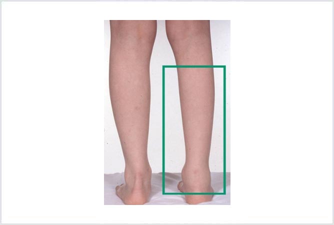 Signs and symptoms of Gout