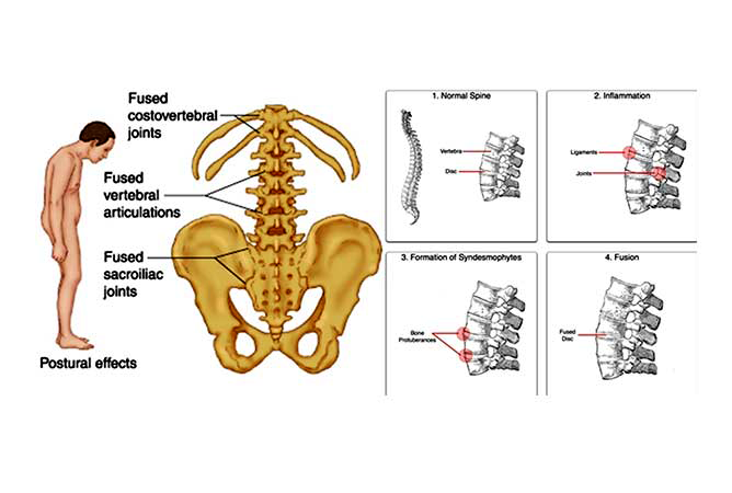 ankylosing-spondylitis